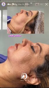 نمونه کار رفع غبغب دکتر نعیمه ارگنجی