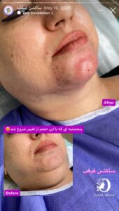 نمونه کار رفع غبغب دکتر نعیمه ارگنجی