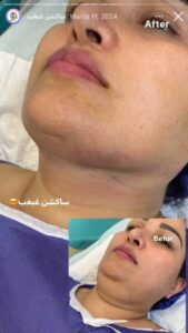 نمونه کار رفع غبغب دکتر نعیمه ارگنجی
