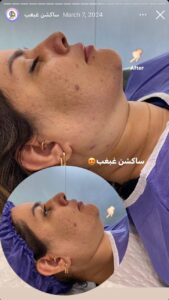 نمونه کار رفع غبغب دکتر نعیمه ارگنجی