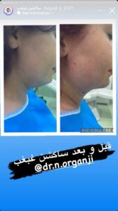 نمونه کار رفع غبغب دکتر نعیمه ارگنجی