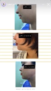 نمونه کار رفع غبغب دکتر نعیمه ارگنجی