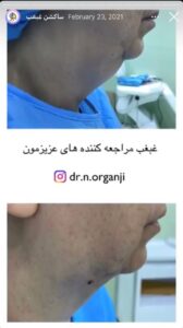 نمونه کار رفع غبغب دکتر نعیمه ارگنجی
