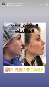 نمونه کار رفع غبغب دکتر پدرام مجاور در مشهد