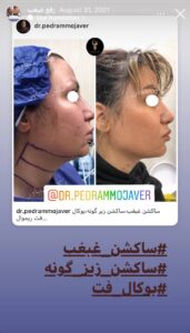 نمونه کار رفع غبغب دکتر پدرام مجاور در مشهد