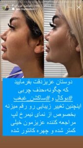 نمونه کار رفع غبغب دکتر پدرام مجاور در مشهد