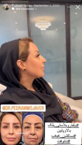 نمونه کار رفع غبغب دکتر پدرام مجاور در مشهد