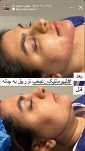 نمونه کار رفع غبغب دکتر پدرام مجاور در مشهد