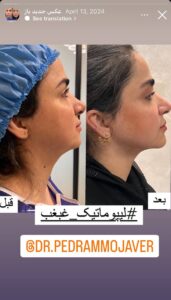 نمونه کار رفع غبغب دکتر پدرام مجاور در مشهد