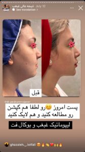 نمونه کار رفع غبغب دکتر پدرام مجاور در مشهد