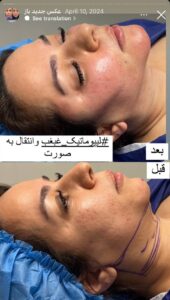 نمونه کار رفع غبغب دکتر پدرام مجاور در مشهد