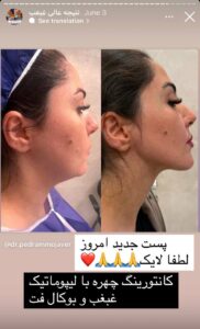 نمونه کار رفع غبغب دکتر پدرام مجاور در مشهد