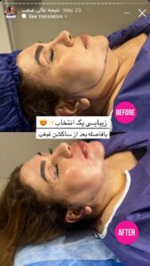 نمونه کار رفع غبغب دکتر پدرام مجاور در مشهد