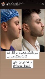 نمونه کار رفع غبغب دکتر پدرام مجاور در مشهد