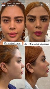 نمونه کار رفع غبغب دکتر پدرام مجاور در مشهد