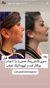 نمونه کار رفع غبغب دکتر پدرام مجاور در مشهد
