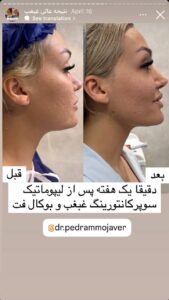 نمونه کار رفع غبغب دکتر پدرام مجاور در مشهد