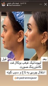 نمونه کار رفع غبغب دکتر پدرام مجاور در مشهد