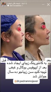 نمونه کار رفع غبغب دکتر پدرام مجاور در مشهد