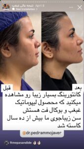 نمونه کار رفع غبغب دکتر پدرام مجاور در مشهد