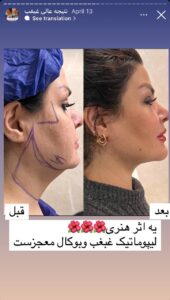 نمونه کار رفع غبغب دکتر پدرام مجاور در مشهد