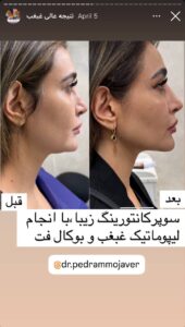 نمونه کار رفع غبغب دکتر پدرام مجاور در مشهد