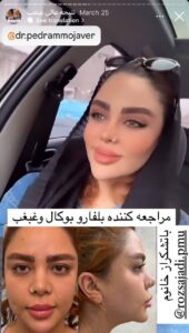 نمونه کار رفع غبغب دکتر پدرام مجاور در مشهد