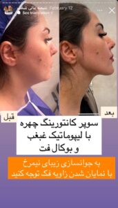 نمونه کار رفع غبغب دکتر پدرام مجاور در مشهد