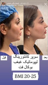 نمونه کار رفع غبغب دکتر پدرام مجاور در مشهد