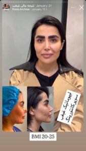 نمونه کار رفع غبغب دکتر پدرام مجاور در مشهد
