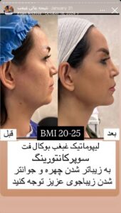 نمونه کار رفع غبغب دکتر پدرام مجاور در مشهد
