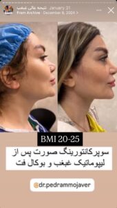 نمونه کار رفع غبغب دکتر پدرام مجاور در مشهد