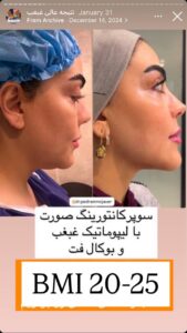 نمونه کار رفع غبغب دکتر پدرام مجاور در مشهد