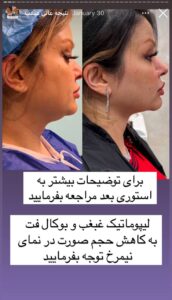 نمونه کار رفع غبغب دکتر پدرام مجاور در مشهد