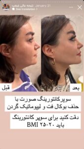 نمونه کار رفع غبغب دکتر پدرام مجاور در مشهد