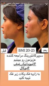 نمونه کار رفع غبغب دکتر پدرام مجاور در مشهد