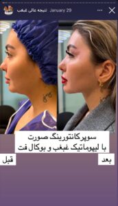 نمونه کار رفع غبغب دکتر پدرام مجاور در مشهد