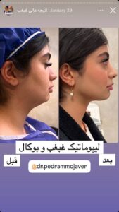 نمونه کار رفع غبغب دکتر پدرام مجاور در مشهد