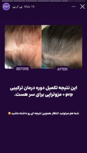 نمونه کار پی آر پی کلینیک شاپرک در مشهد