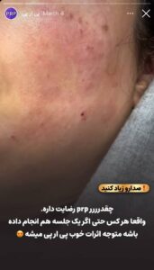 نمونه کار پی آر پی کلینیک شاپرک در مشهد