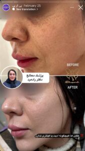 نمونه کار پی آر پی کلینیک شاپرک در مشهد