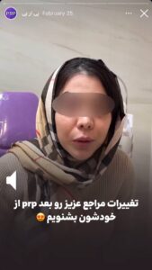 نمونه کار پی آر پی کلینیک شاپرک در مشهد