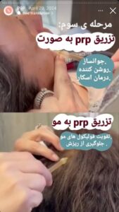 نمونه کار پی آر پی دکتر مژگان کلالی در مشهد