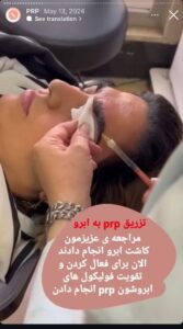 نمونه کار پی آر پی دکتر مژگان کلالی در مشهد