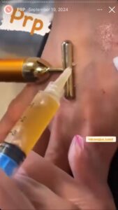 نمونه کار پی آر پی دکتر مژگان کلالی در مشهد