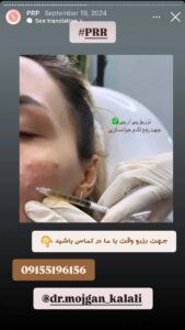 نمونه کار پی آر پی دکتر مژگان کلالی در مشهد