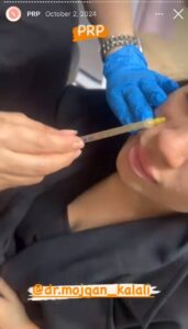 نمونه کار پی آر پی دکتر مژگان کلالی در مشهد