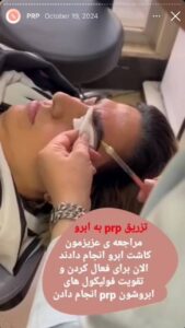 نمونه کار پی آر پی دکتر مژگان کلالی در مشهد