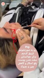 نمونه کار پی آر پی دکتر مژگان کلالی در مشهد