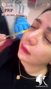 نمونه کار پی آر پی دکتر مژگان کلالی در مشهد